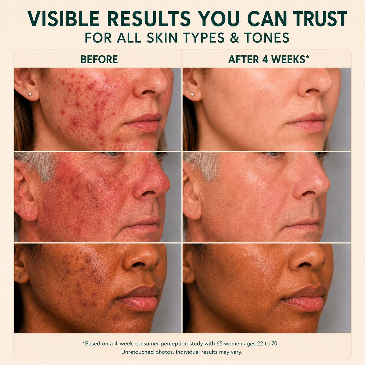 Azelaic Acid Soothing Serum